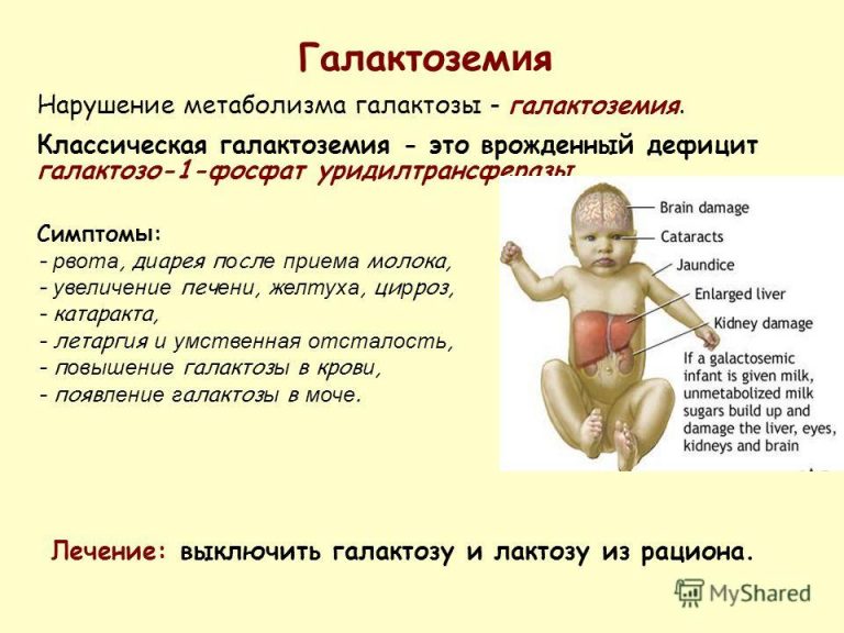 Галактоземия | Справка.Неинвалид.ru